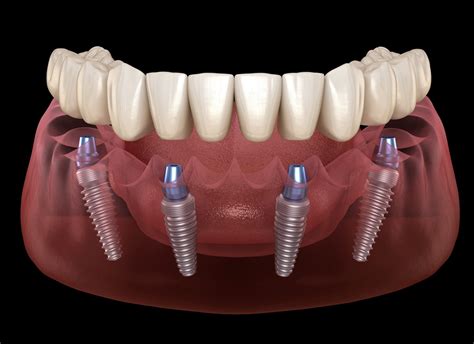affordable all on 4 implants